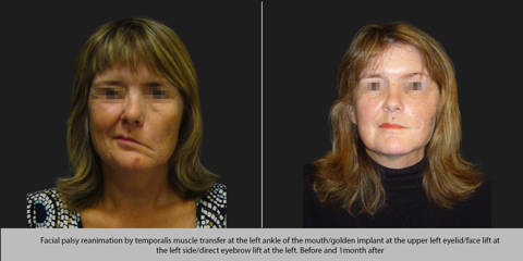 Before and after photos for facial palsy with temporalis muscle transfer, golden eyelid implant, and facelift