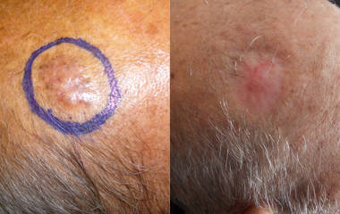 Skin cancer removal showing lesion on scalp before and after surgery and healed skin after treatment