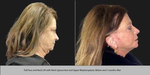 Before and 2 months after full face and neck lift with neck liposuction and upper blepharoplasty