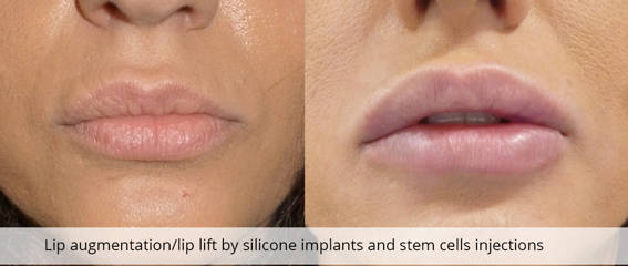 Before and after lip augmentation and lip lift silicone implants and stem cells injections
