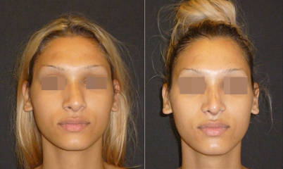 Frontal view before and after rhinoplasty showing  improved nasal symmetry and contour