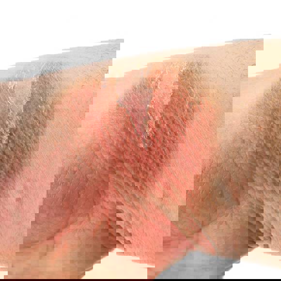 Close up of a mild skin burn on the hand showing redness and peeling