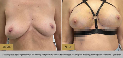 Breast augmentation and lift with 375cc high profile round silicone implants, showing improved shape and projection