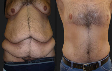 Before and after body contouring surgery showing improved waistline and smoother torso