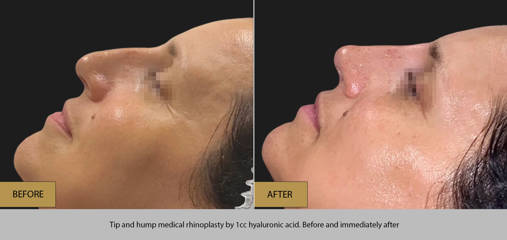 Close up side view of woman lying down before and after medical rhinoplasty with 1 cc hyaluronic acid