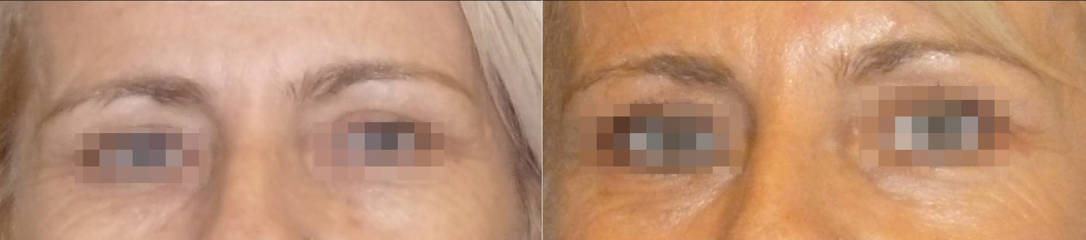 Before and after skin resurfacing with laser around the eye area showing smoother texture 