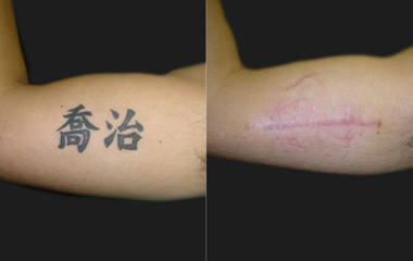 Tattoo removal before and after on the inner upper arm showing faded ink and smoother skin