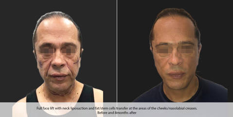 Before and 8 months after full face lift with neck liposuction and fat/stem cells transfer 