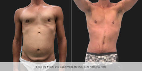 Male high definition abdominoplasty with hernia repair and four weeks after surgery