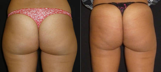 Before and after image of buttocks and thighs showing visible fat reduction and smoother contours following liposuction