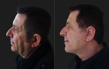 Side view before and after side-profile of a facelift showing refined jawline and tightened neck contour