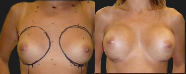 Before and after breast augmentation showing enhanced volume and natural contour