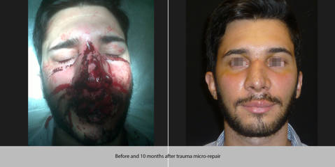 Before and after comparison of a man with severe facial trauma and 10 months after micro repair surgery, significantly recovered