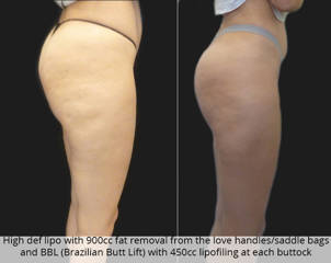Before and after high-definition liposuction and Brazilian Butt Lift showing enhanced curves and smoother contour