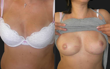 Before and afte breast reconstruction treatment results with improved symmetry and natural contour