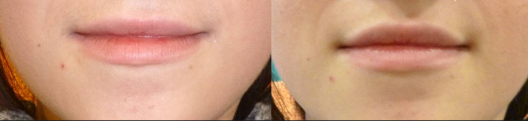 Before and after lip filler treatment with hyaluronic acid injection showing enhanced lip volume