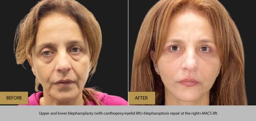 Before and after results of upper and lower blepharoplasty with eyelid lift, right-eye blepharoptosis correction