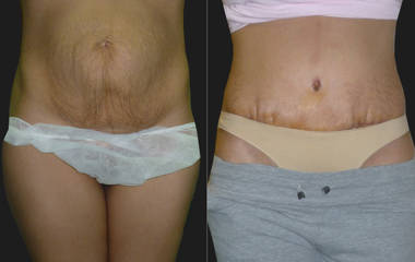 Before and after abdominoplasty showing flatter abdomen with enhanced contour and defined waistline