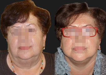 Before and after facelift showing refined jawline and smoother neck contour