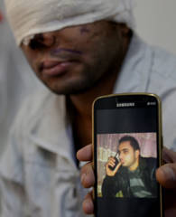 Reconstructive surgery patient showing pre injury photo