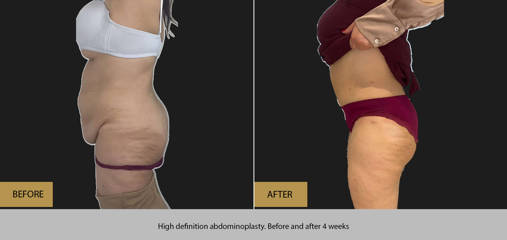 Before and after high definition abdominoplasty showing sculpted abdomen and enhanced waist contour