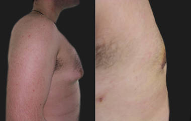 Side view before and after gynecomastia surgery showing reduced chest projection and natural contour