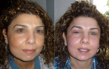 Before and after comparison of a woman's face showing improved brightness and reduced pigmentation