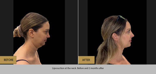 Before and after neck liposuction showing improved jawline contour and reduced double chin after 2 months
