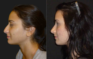 Side view before and after female rhinoplasty showing reduction of nasal hump and refined nasal bridge