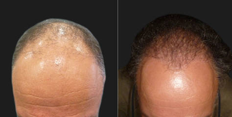Before and after of hair transplantation showing increased hair density and improved scalp coverage