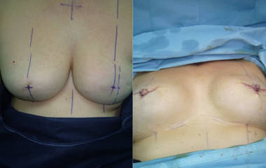 Before and after intraoperative images showing breast reconstruction surgery with marked incision lines