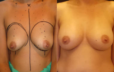 Before and after breast augmentation with silicone implants showing fuller shape and natural symmetry