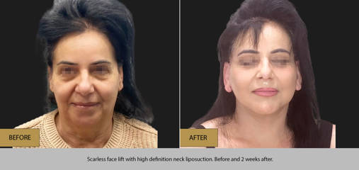 Before and after scarless face lift with high definition neck liposuction