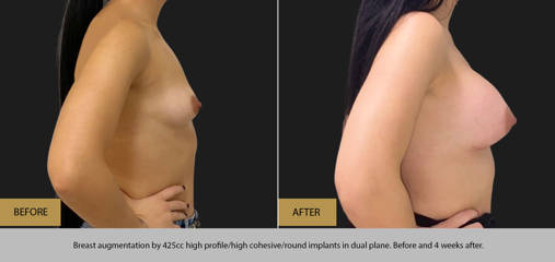 Breast augmentation by 425cc high profile implants in dual plane, before and 4 weeks after