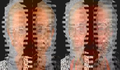 Before and after facelift showing refined jawline and neck contour with subtle and natural rejuvenation