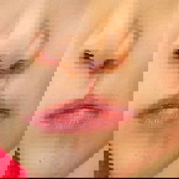 Close up of healed surgical scar on upper lip after cleft lip repair