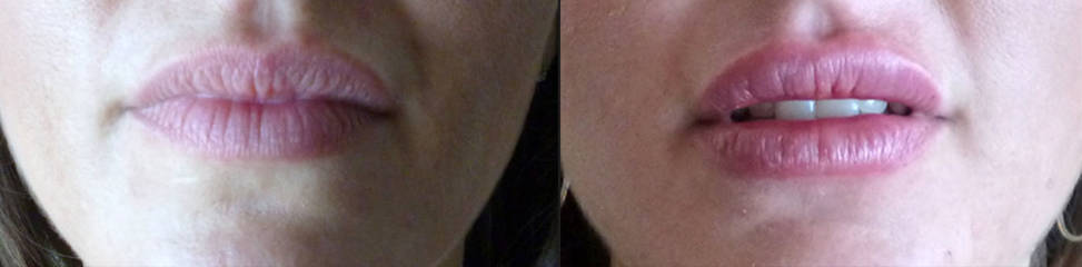 Before and lip filler treatment showing enhanced lip volume and refined lip border