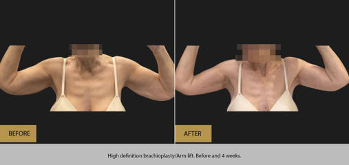 High definition brachioplasty/ arm lift. Before and 4 weeks