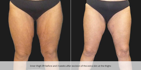 Inner thigh lift before and 3 weeks after excision of the extra skin at the thighs