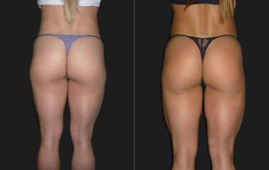 Before and after high-definition liposuction and buttock contouring showing smoother, sculpted thighs and lifted appearance