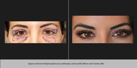 Before and after upper and lower blepharoplasty with canthopexy and eyelift showing rejuvenated eye area