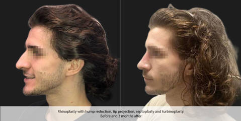 Male profile before and 3 months after rhinoplasty with dorsal hump reduction, improved tip projection and septoplasty