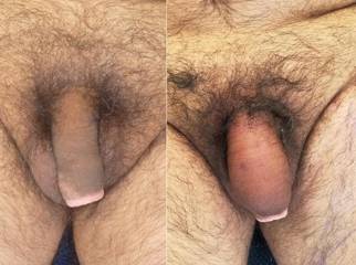 Before and after male genital aesthetic surgery 