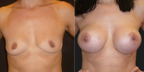 Befre and after breast augmentation showing enhanced volume and refined contour