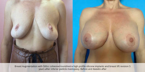 Before and after breast lift revision with 500cc implants showing fuller shape and lifted contour