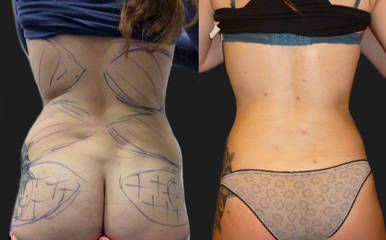 Before and after back and waist liposuction showing slimmer contour and reduced fat