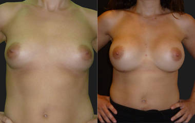 Before and after breast augmentation showing improved fullness, projection and balanced proportions