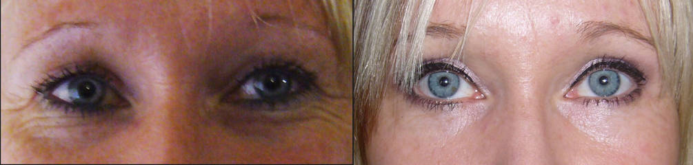 Upper and lower blepharoplasty before and after, showing smoother eyelid area and rejuvenated eye appearance