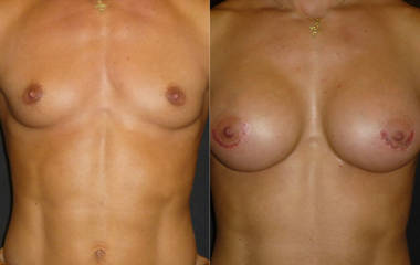 Before and after breast augmentation with silicon implants showing improved fullness and projection