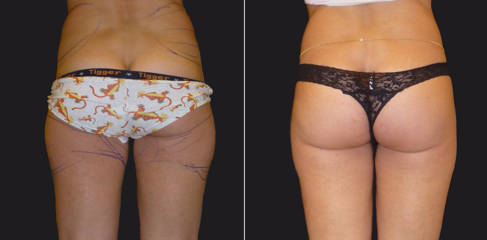 Before and after liposuction showing sculpted waistline and enhanced buttock contour